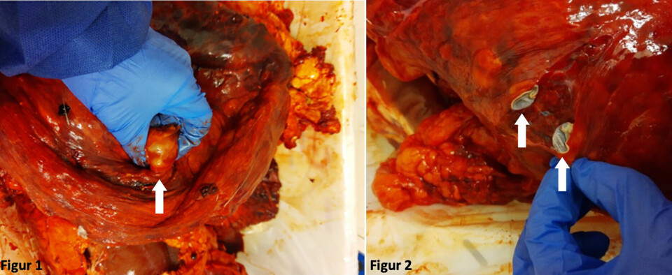 Disse bildene viser hvordan parasittblærer fra hundens dvergbendelorm ser ut i lunge hos elg.